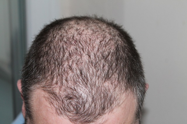Home Remedies for Treating Hair Loss in Canada