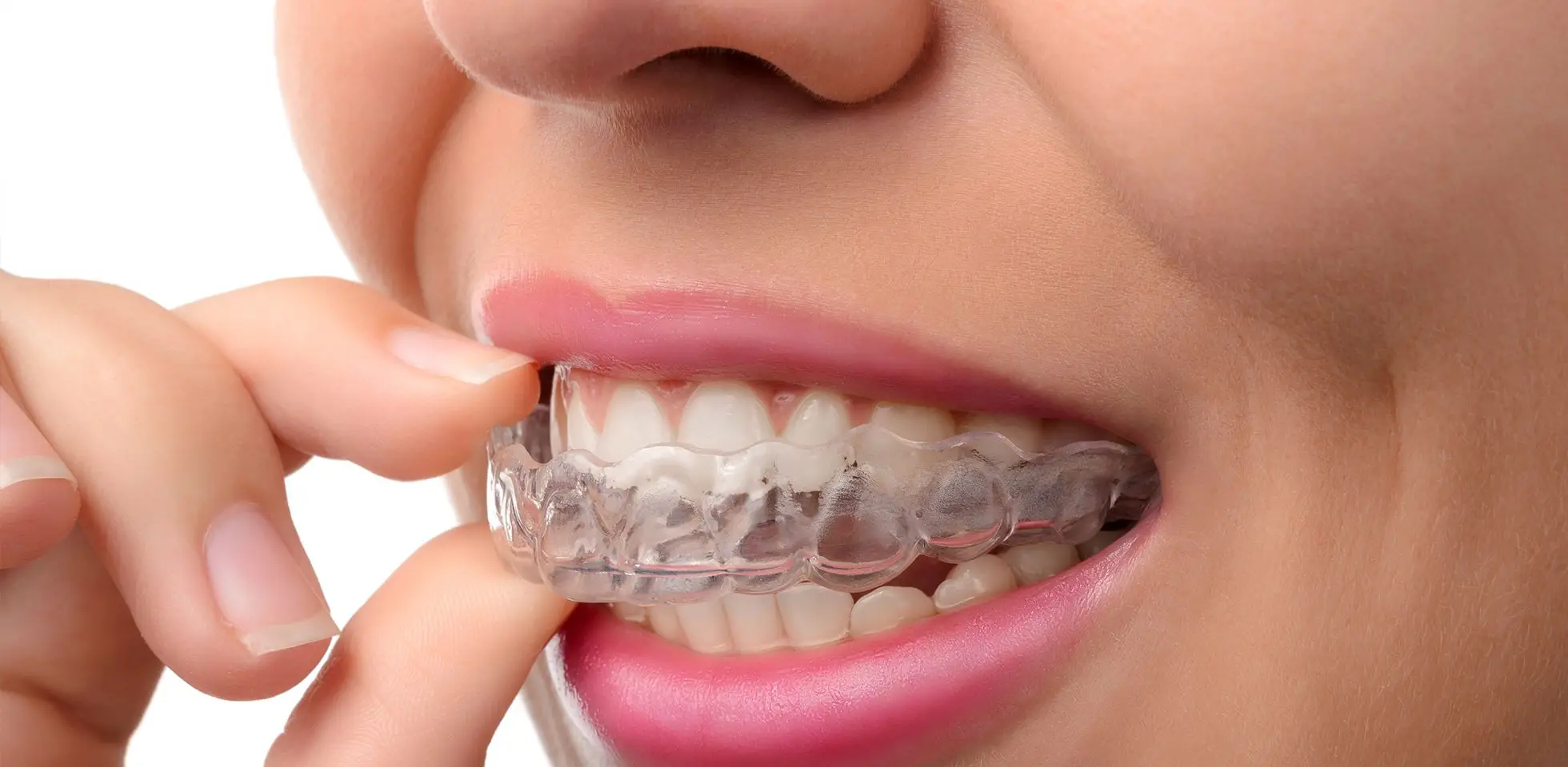 Things you need to know about Invisalign treatment before you opt-in for it