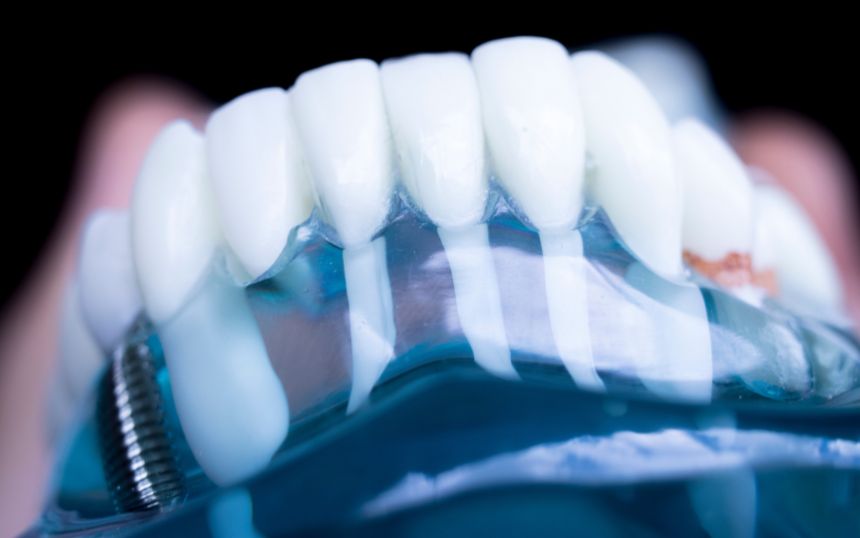 Dental Implants for Seniors: The Types and Benefits